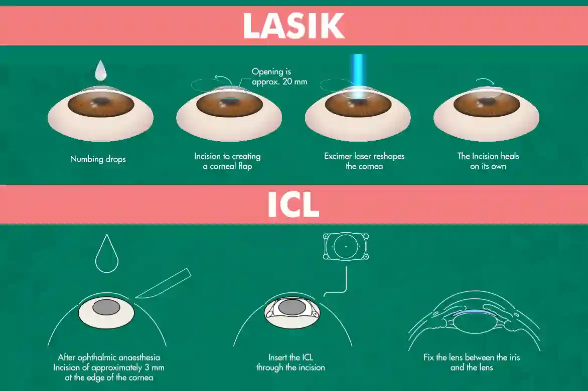 Comparison of ICL vs LASIK: Cutting edge vision correction
